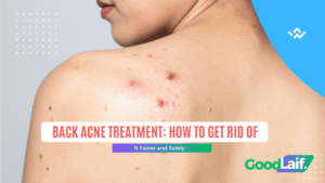 Example of back acne and how to treat it with back acne treatment