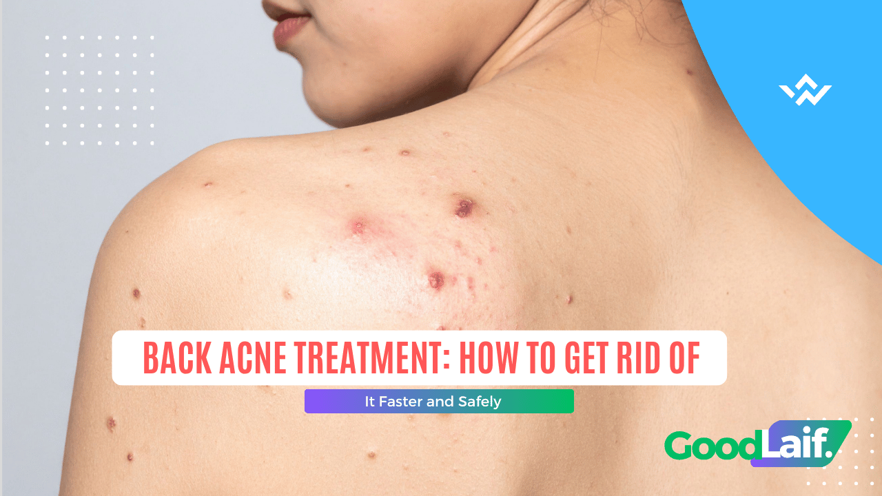 Example of back acne and how to treat it with back acne treatment