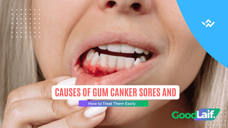 Causes of Gum Canker Sores and How to Treat Them Easily