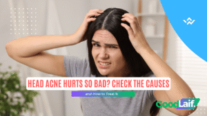 woman in pain holding her head due to painful and inflamed head acne