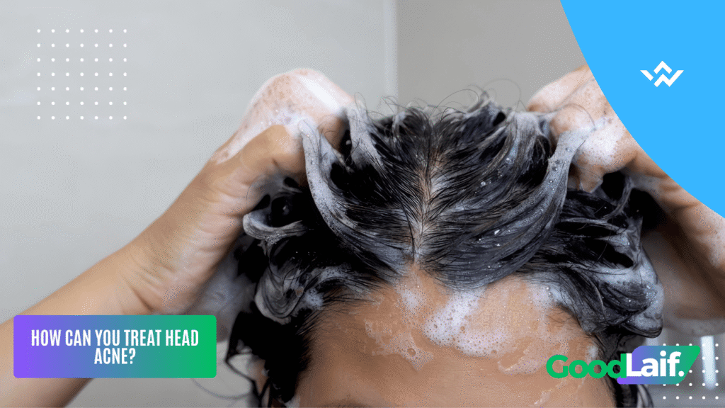how to wash scalp properly to treat head acne